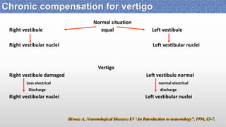 Normal situation
Right vestibule equal Left vestibule
Right vestibular nuclei Left vestibular nuclei
Vertigo
Right vestibule damaged Left vestibule normal
Less electrical normal electrical
Discharge discharge
Right vestibular nuclei Left vestibular nuclei
Biswas A, Neurotological Diseases IN ‘An Introduction to neurotology”, 1998, 85-7.
Chronic compensation for vertigo
 