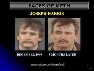 19
JOSEPH HARRIS
DECEMBER 1999 3 MONTHS LATER
www.yahoo.com/facesofmeth
FACES OF METH
 
