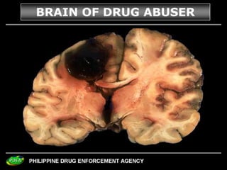 23
BRAIN OF DRUG ABUSER
 