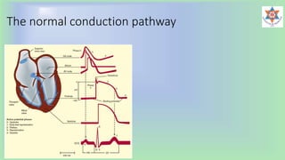 The normal conduction pathway
 