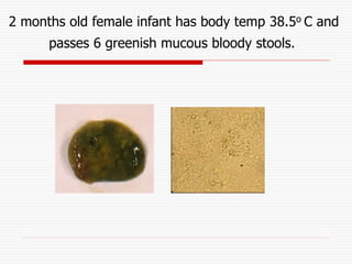 2 months old female infant has body temp 38.5o C and
passes 6 greenish mucous bloody stools.
 