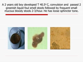 A 2 years old boy developed T 40.5o C, convulsion and passed 2
greenish liquid foul smell stools followed by frequent smal...