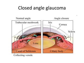 Closed angle glaucoma
 