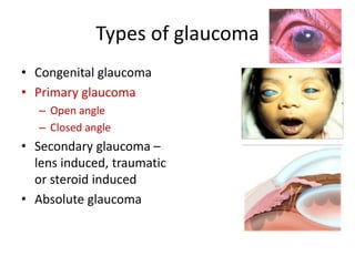 Types of glaucoma
• Congenital glaucoma
• Primary glaucoma
– Open angle
– Closed angle
• Secondary glaucoma –
lens induced, traumatic
or steroid induced
• Absolute glaucoma
 