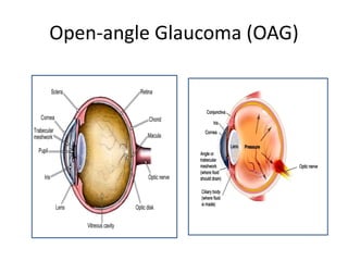 Open-angle Glaucoma (OAG)
 