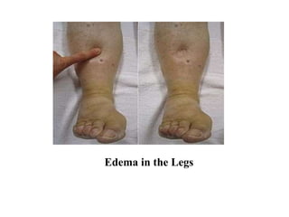 Edema in the Legs
 