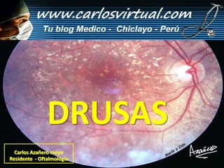DRUSAS
  Carlos Azañero Inope
Residente - Oftalmología
 