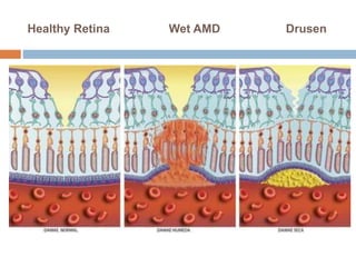 Healthy Retina Wet AMD Drusen
 