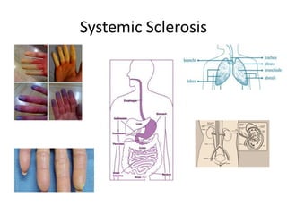 Current and future treatment option for Systemic Sclerosis | PDF
