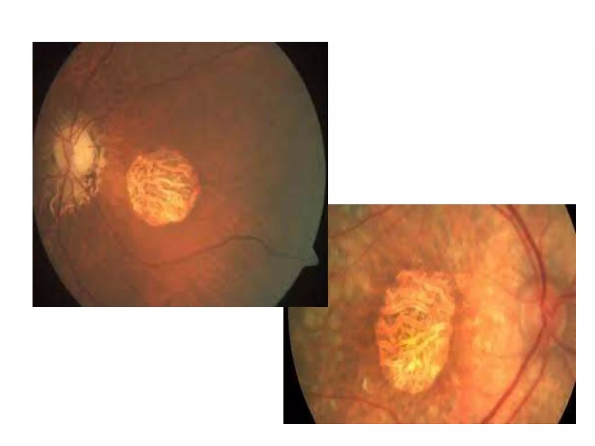 DRY AGE RELATED MACULAR DEGENERATION | PPTX