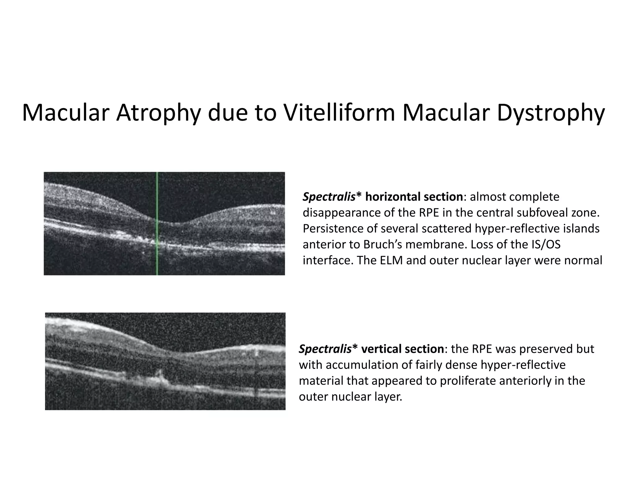 DRY AGE RELATED MACULAR DEGENERATION | PPTX