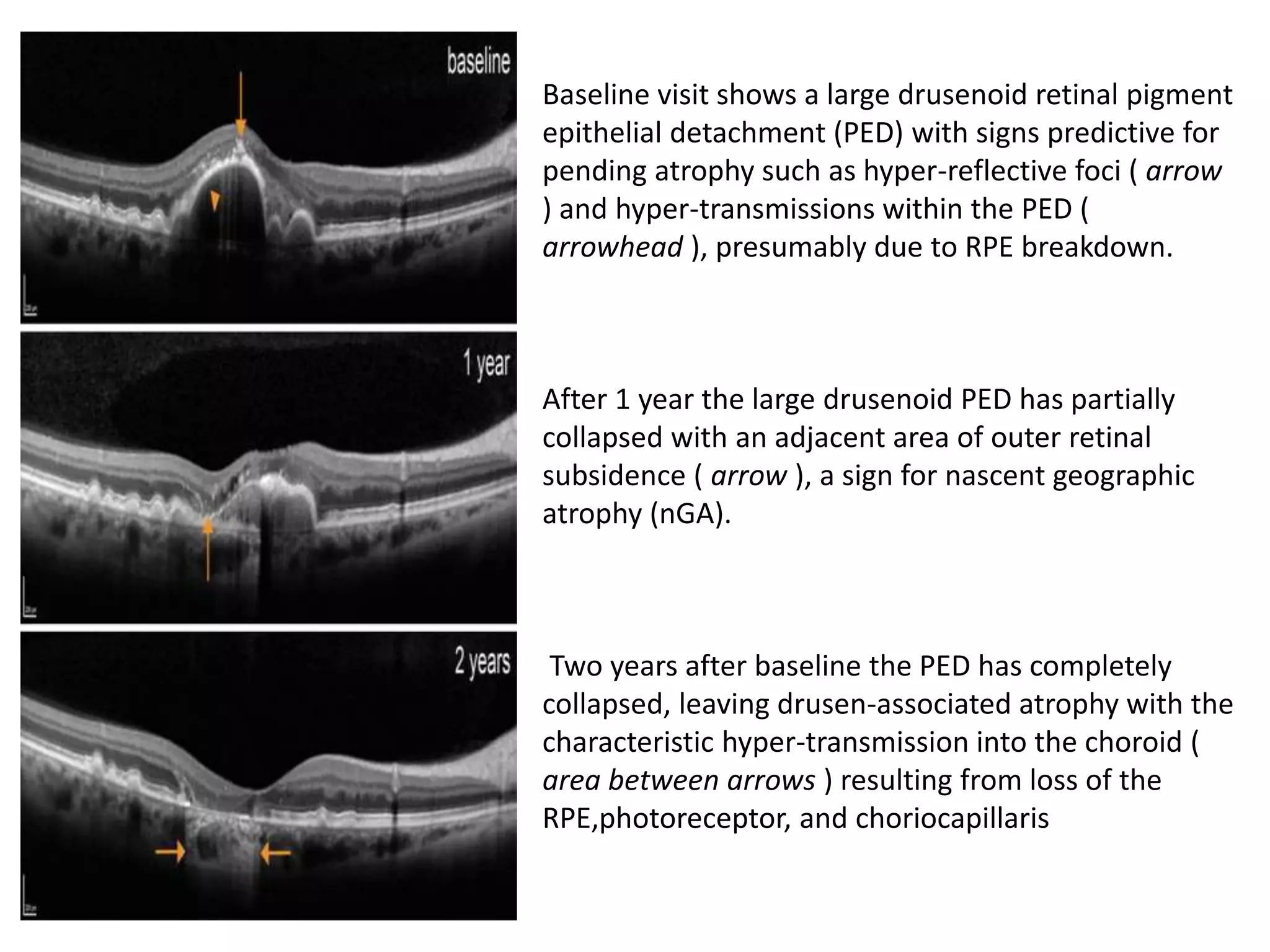 DRY AGE RELATED MACULAR DEGENERATION | PPTX