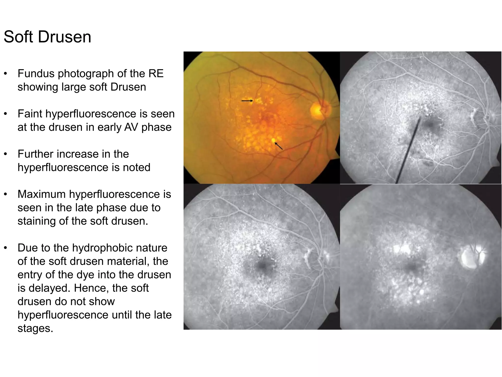 DRY AGE RELATED MACULAR DEGENERATION | PPTX