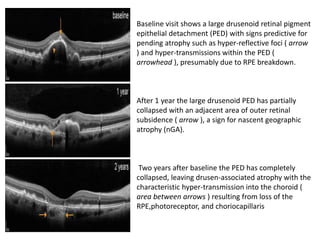 DRY AGE RELATED MACULAR DEGENERATION | PPTX