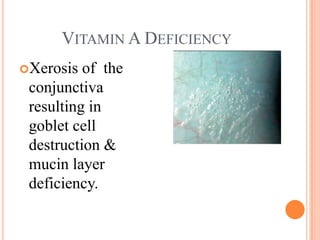 VITAMIN A DEFICIENCY
Xerosis  of the
 conjunctiva
 resulting in
 goblet cell
 destruction &
 mucin layer
 deficiency.
 