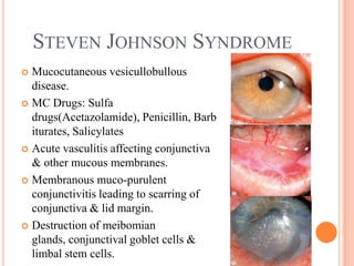 STEVEN JOHNSON SYNDROME
 Mucocutaneous vesicullobullous
  disease.
 MC Drugs: Sulfa
  drugs(Acetazolamide), Penicillin, Barb
  iturates, Salicylates
 Acute vasculitis affecting conjunctiva
  & other mucous membranes.
 Membranous muco-purulent
  conjunctivitis leading to scarring of
  conjunctiva & lid margin.
 Destruction of meibomian
  glands, conjunctival goblet cells &
  limbal stem cells.
 