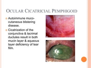 OCULAR CICATRICIAL PEMPHIGOID
 Autoimmune muco-
  cutaneous blistering
  disease.
 Cicatrization of the
  conjunctiva & lacrimal
  ductules result in both
  mucin layer & aqueous
  layer deficiency of tear
  film.
 