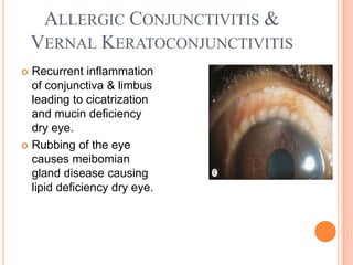 ALLERGIC CONJUNCTIVITIS &
    VERNAL KERATOCONJUNCTIVITIS
 Recurrent inflammation
  of conjunctiva & limbus
  leading to cicatrization
  and mucin deficiency
  dry eye.
 Rubbing of the eye
  causes meibomian
  gland disease causing
  lipid deficiency dry eye.
 