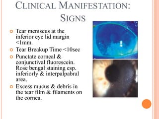 CLINICAL MANIFESTATION:
             SIGNS
   Tear meniscus at the
    inferior eye lid margin
    <1mm.
   Tear Breakup Time <10sec
   Punctate corneal &
    conjunctival fluorescein.
    Rose bengal staining esp.
    inferiorly & interpalpabral
    area.
   Excess mucus & debris in
    the tear film & filaments on
    the cornea.
 