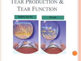 TEAR PRODUCTION &
  TEAR FUNCTION
  Healthy tear film   Dry eye
 
