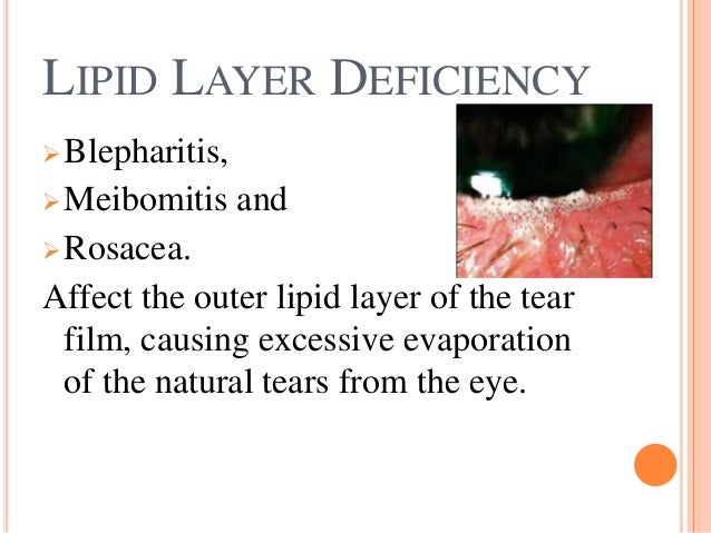 Dry eye: An Overview