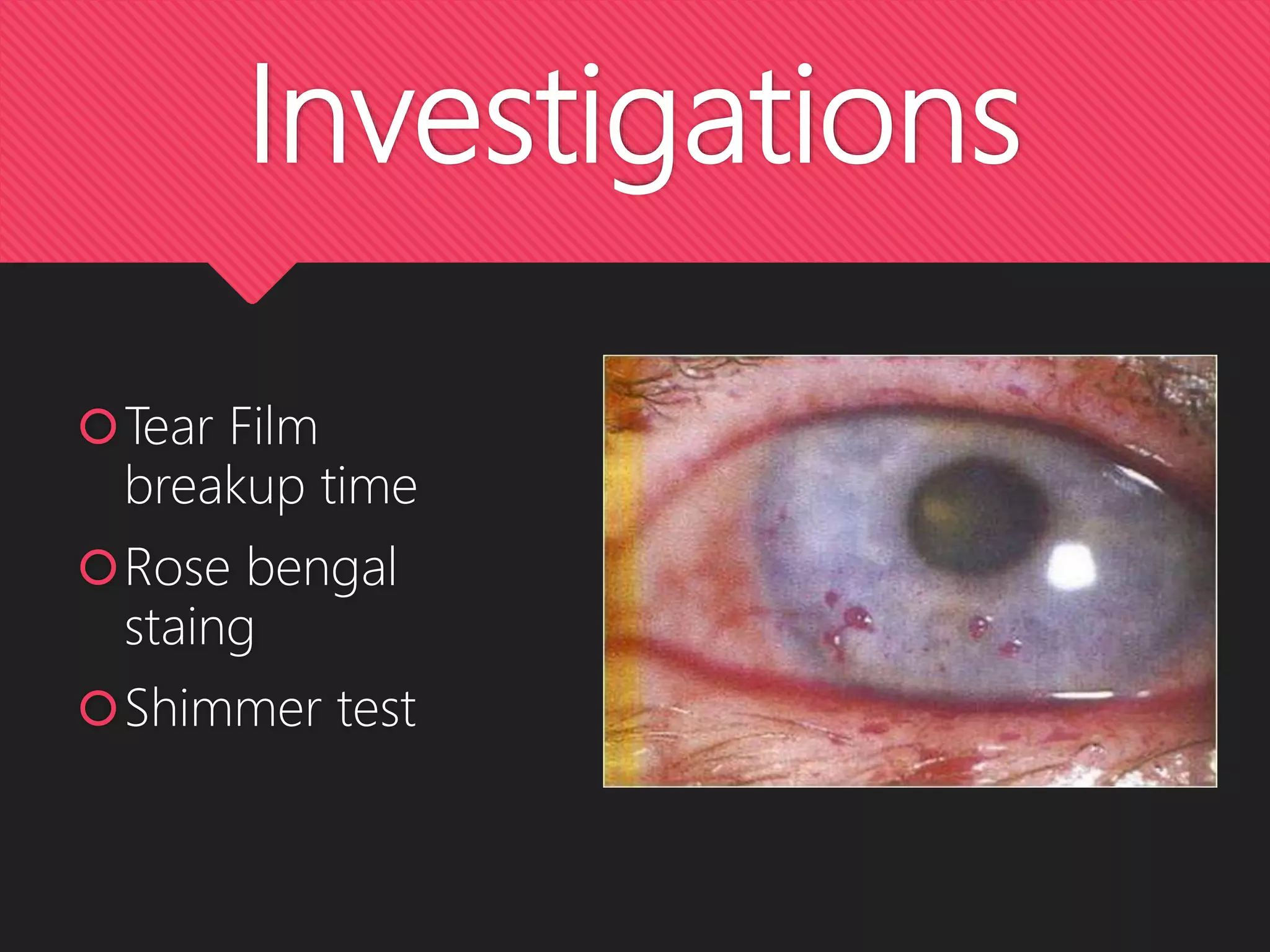 Investigations
Tear Film
breakup time
Rose bengal
staing
Shimmer test