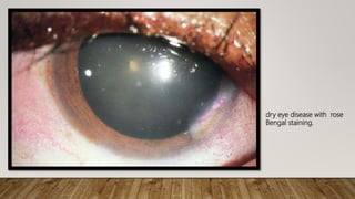 dry eye disease with rose
Bengal staining.
 