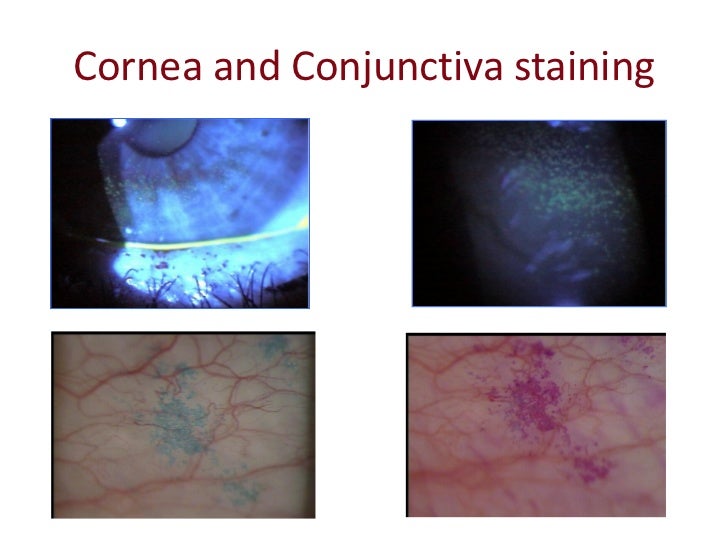 Keratoconus and Dry Eye