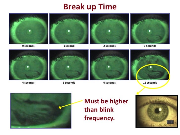 Keratoconus and Dry Eye