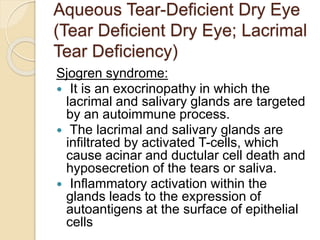 Aqueous Tear-Deficient Dry Eye
(Tear Deficient Dry Eye; Lacrimal
Tear Deficiency)
Sjogren syndrome:
 It is an exocrinopathy in which the
lacrimal and salivary glands are targeted
by an autoimmune process.
 The lacrimal and salivary glands are
infiltrated by activated T-cells, which
cause acinar and ductular cell death and
hyposecretion of the tears or saliva.
 Inflammatory activation within the
glands leads to the expression of
autoantigens at the surface of epithelial
cells
 