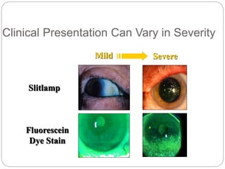Slitlamp
Fluorescein
Dye Stain
Mild Severe
Clinical Presentation Can Vary in Severity
 