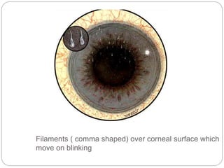 Filaments ( comma shaped) over corneal surface which
move on blinking
 