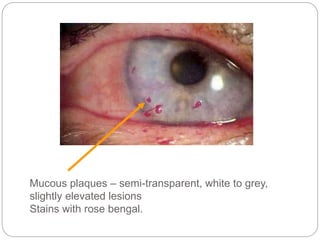 Mucous plaques – semi-transparent, white to grey,
slightly elevated lesions
Stains with rose bengal.
 