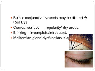  Bulbar conjunctival vessels may be dilated 
Red Eye.
 Corneal surface – irregularity/ dry areas.
 Blinking – incomplete/infrequent.
 Meibomian gland dysfunction/ blepharitis.
 