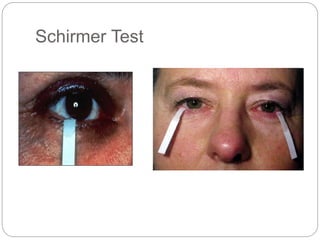 Schirmer Test
 