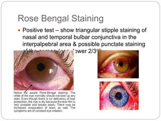 Rose Bengal Staining
 Positive test – show triangular stipple staining of
nasal and temporal bulbar conjunctiva in the
interpalpebral area & possible punctate staining
of the cornea (esp. lower 2/3rd).
 