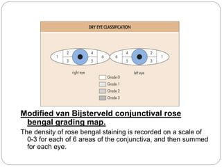Modified van Bijsterveld conjunctival rose
bengal grading map.
The density of rose bengal staining is recorded on a scale of
0-3 for each of 6 areas of the conjunctiva, and then summed
for each eye.
 