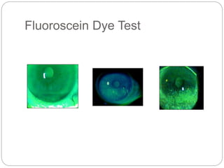 Fluoroscein Dye Test
 