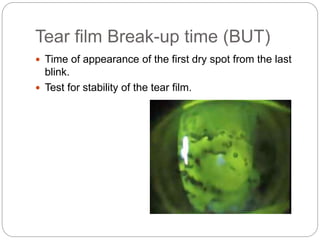 Tear film Break-up time (BUT)
 Time of appearance of the first dry spot from the last
blink.
 Test for stability of the tear film.
 