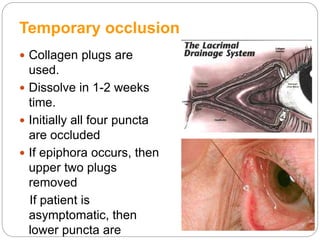 Temporary occlusion
 Collagen plugs are
used.
 Dissolve in 1-2 weeks
time.
 Initially all four puncta
are occluded
 If epiphora occurs, then
upper two plugs
removed
If patient is
asymptomatic, then
lower puncta are
 
