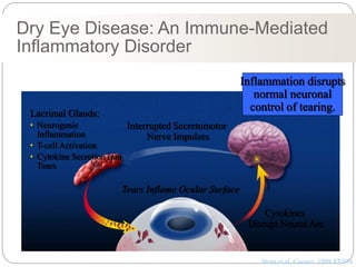 Lacrimal Glands:
• Neurogenic
Inflammation
• T-cell Activation
• Cytokine Secretion into
Tears
Interrupted Secretomotor
Nerve Impulses
Tears Inflame Ocular Surface
Cytokines
Disrupt Neural Arc
Inflammation disrupts
normal neuronal
control of tearing.
Stern et al, Cornea. 1998:17:584
Dry Eye Disease: An Immune-Mediated
Inflammatory Disorder
 