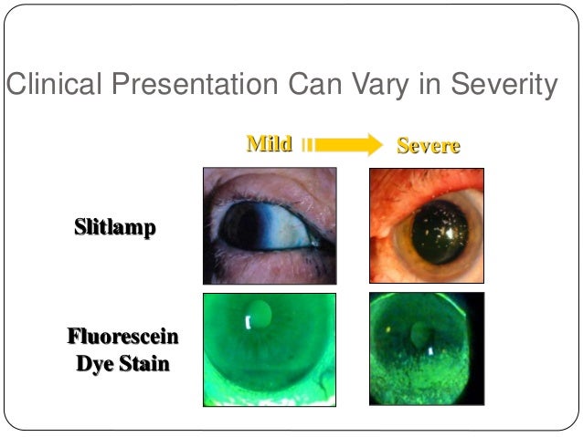Dry Eye Test Results