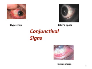 Conjunctival
Signs
Hyperemia Bitot’s spots
Symblepheron
16
 
