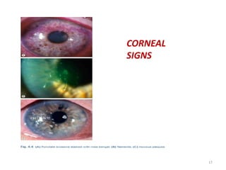CORNEAL
SIGNS
17
 