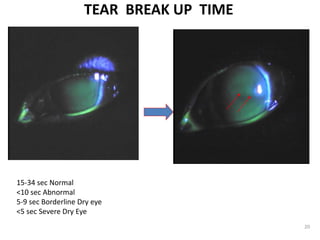 TEAR BREAK UP TIME
15-34 sec Normal
<10 sec Abnormal
5-9 sec Borderline Dry eye
<5 sec Severe Dry Eye
20
 