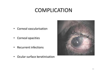 COMPLICATION
• Corneal vascularisation
• Corneal opacities
• Recurrent infections
• Ocular surface keratinisation
31
 