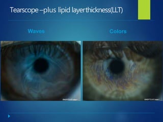 Tearscope–plus lipid layerthickness(LLT)
Waves Colors
 