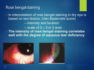 Rose bengalstaining
In interpretation of rose bengal staining in dry eye is
based on two factors :(Van Bijsterveld score)
– intensity and location
– scale of 0 – 3 in 3 area
The intensity of rose bengal staining correlates
well with the degree of aqueous tear deficiency
 