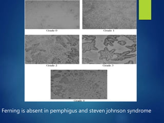 Ferning is absent in pemphigus and steven johnson syndrome
 