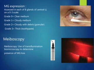 MG expression :
Assessed in each of 8 glands of central LL
on a 0-3 scale:
Grade 0= Clear meibum
Grade 1= Cloudy meibum
Grade 2= Cloudy with debris (granular)
Grade 3= Thick (toothpaste)
Meiboscopy: Use of transillumination
biomicroscopy to determine
presence of MG loss
Meiboscopy
 